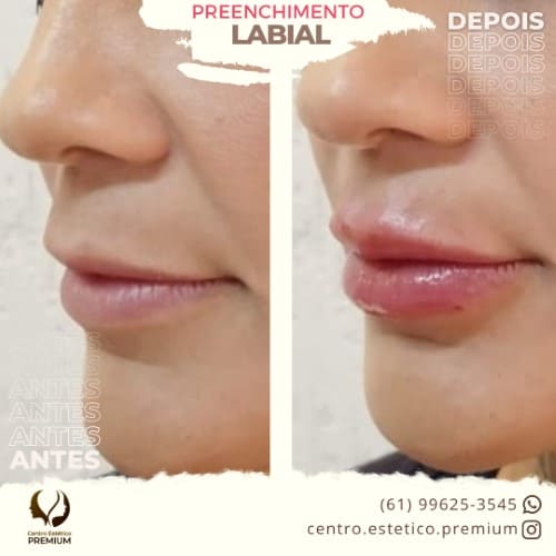 Preenchimento Labial