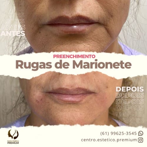 Preenchimento Rugas de Marionete